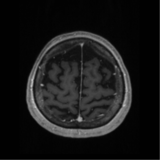 File:Anaplastic astrocytoma IDH wild-type (pseudoprogression) (Radiopaedia 42209-45276 Axial T1 C+ 123).png