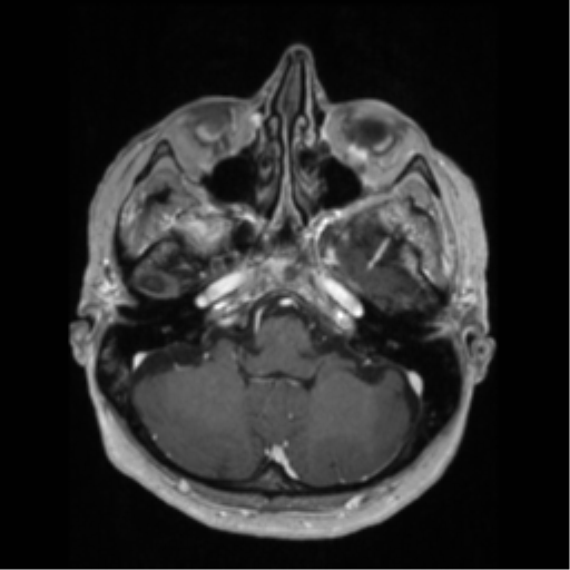 File:Anaplastic astrocytoma IDH wild-type (pseudoprogression) (Radiopaedia 42209-45276 Axial T1 C+ 38).png