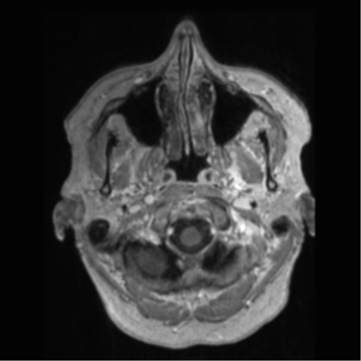 Anaplastic astrocytoma IDH wild-type (pseudoprogression) (Radiopaedia 42209-45277 Axial T1 C+ 3).png
