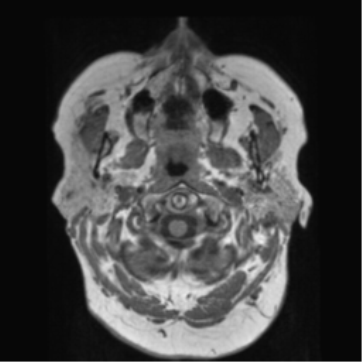 File:Anaplastic astrocytoma IDH wild-type (pseudoprogression) (Radiopaedia 42209-45278 Axial T1 16).png