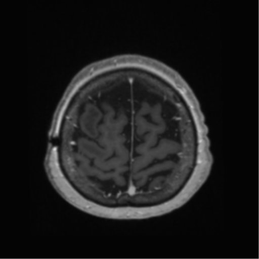 File:Anaplastic astrocytoma IDH wild-type (pseudoprogression) (Radiopaedia 42209-45278 Axial T1 C+ 131).png