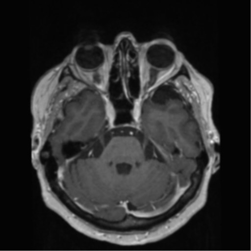 File:Anaplastic astrocytoma IDH wild-type (pseudoprogression) (Radiopaedia 42209-45278 Axial T1 C+ 55).png