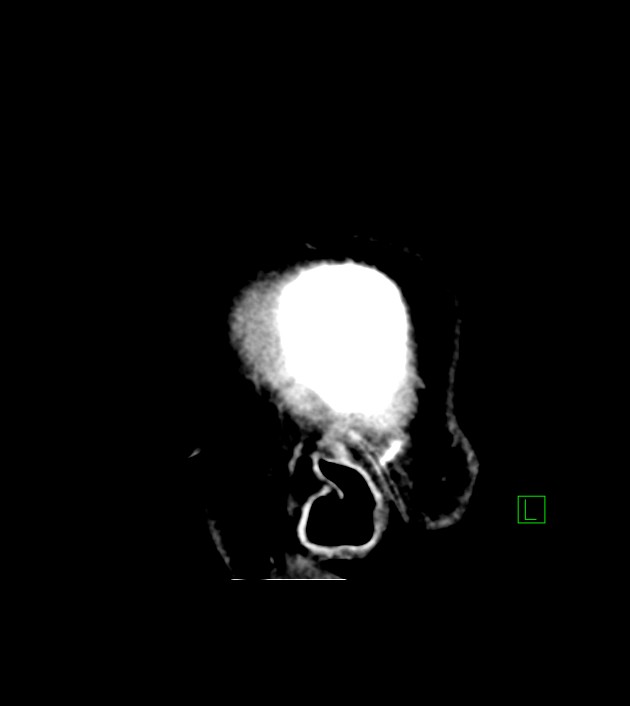 Anaplastic oligodendroglioma (Radiopaedia 79571-92758 C 52).jpg