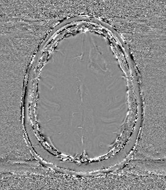 Anaplastic oligodendroglioma (Radiopaedia 83500-98599 Axial SWI - phase 65).png