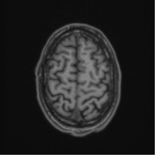 Anaplastic oligodendroglioma with skull fracture (Radiopaedia 74831-85845 Axial T1 56).png