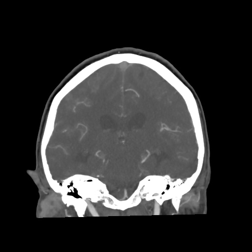 Aneursym related subarachnoid hemorrhage with hydrocephalus (Radiopaedia 45105-49084 B 47).jpg