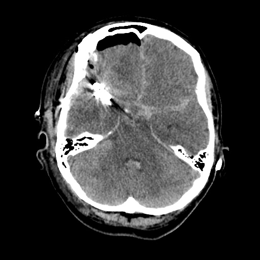 Aneursym related subarachnoid hemorrhage with hydrocephalus (Radiopaedia 45105-49085 Axial non-contrast 14).jpg