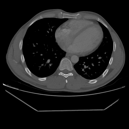 Aneurysmal bone cyst - rib (Radiopaedia 82167-96220 Axial bone window 172).jpg