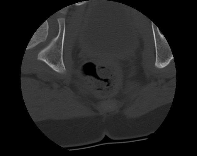 Aneurysmal bone cyst - sacrum (Radiopaedia 65190-74195 Axial bone window 48).jpg