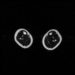 File:Aneurysmal bone cyst - tibia (Radiopaedia 22343-22367 Axial T2 3).jpg
