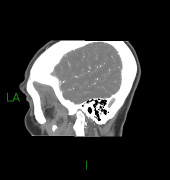 Aneurysmal subarachnoid hemorrhage with intra-axial extension (Radiopaedia 84371-99732 B 10).jpg