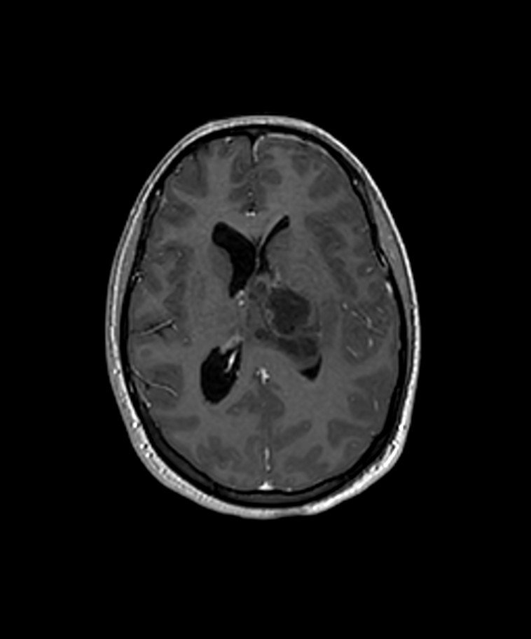 Angiomatous meningioma (Radiopaedia 79459-92577 Axial T1 C+ 3D ISO 10).jpg