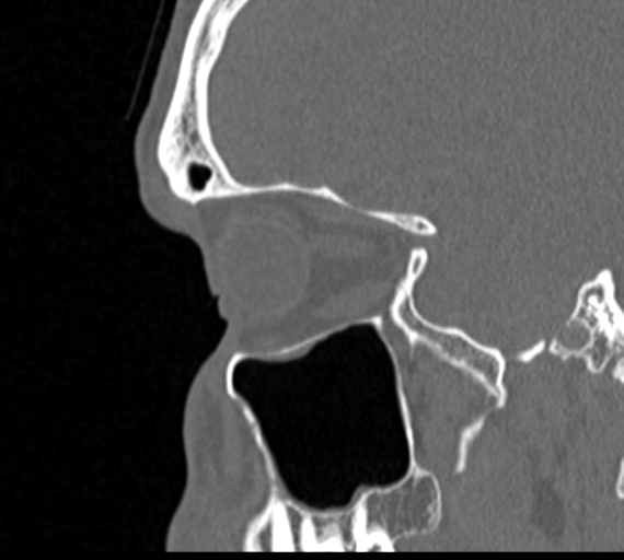 Angular epidermoid cyst (Radiopaedia 46908-51439 Sagittal bone window 20).png