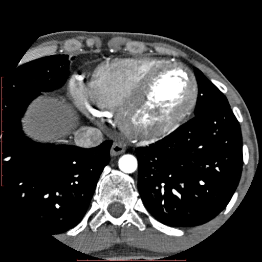 File:Anomalous left coronary artery from the pulmonary artery (ALCAPA) (Radiopaedia 70148-80181 A 308).jpg