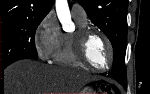 Anomalous left coronary artery from the pulmonary artery (ALCAPA) (Radiopaedia 70148-80181 B 104).jpg