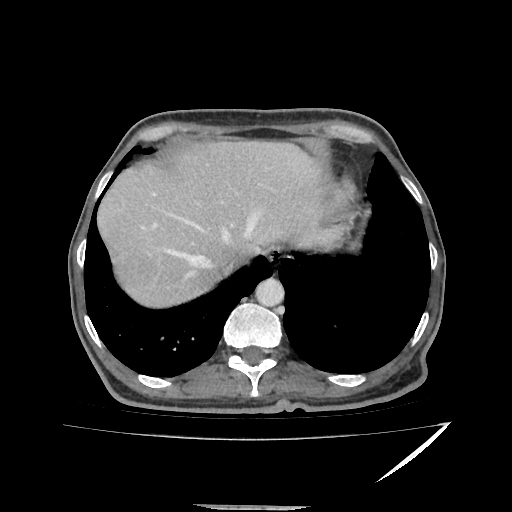 Anorectal carcinoma (Radiopaedia 44413-48064 A 7).jpg