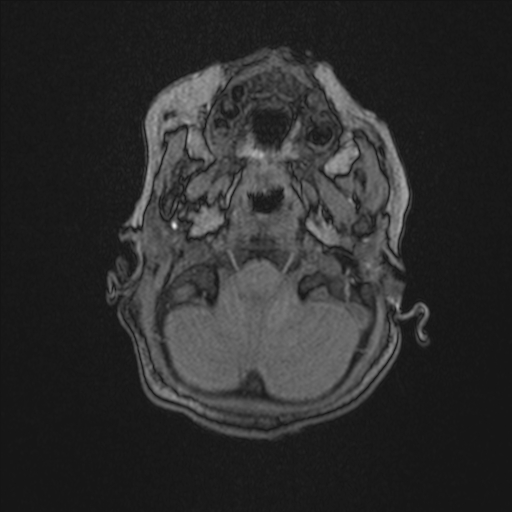 Anoxic brain injury (Radiopaedia 79165-92139 Axial MRA 28).jpg