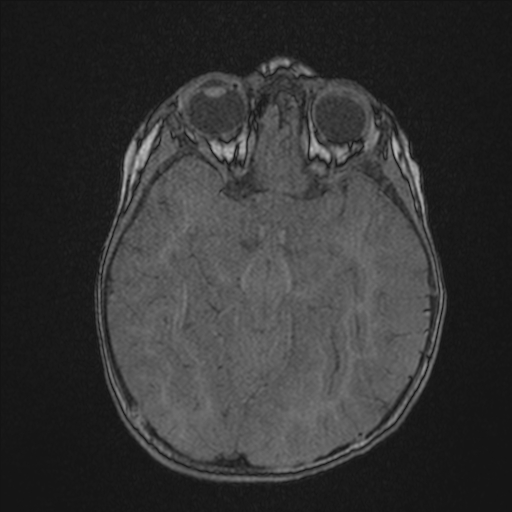 Anoxic brain injury (Radiopaedia 79165-92139 Axial MRA 90).jpg