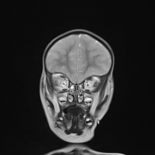 File:Anoxic brain injury (Radiopaedia 79165-92139 Coronal T2 7).jpg