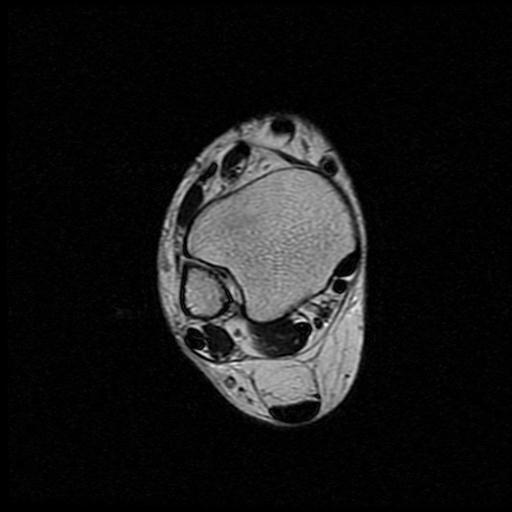 File:Anterior calcaneal process fracture (Radiopaedia 71377-81705 Axial T2 3).jpg