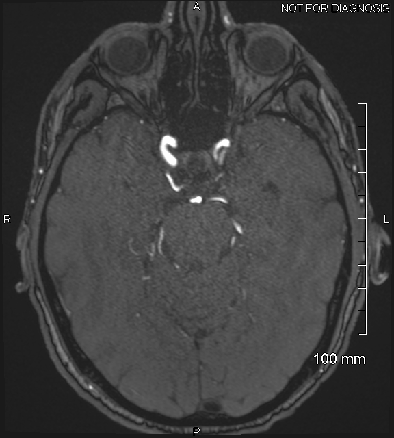 Anterior cerebral artery aneurysm (Radiopaedia 80683-94127 Axial MRA 86).jpg