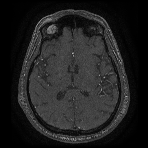 Anterior cerebral artery infarction (Radiopaedia 46794-51323 Axial MRA 120).jpg