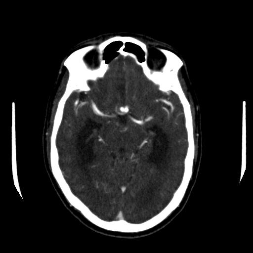 File:Anterior communicating artery aneurysm (Radiopaedia 16633-16335 A 18).jpg