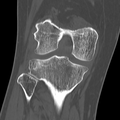 File:Anterior cruciate ligament avulsion fracture (Radiopaedia 58939-66194 Coronal bone window 20).jpg