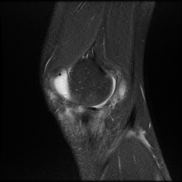 File:Anterior cruciate ligament graft tear and bucket-handle tear of medial meniscus (Radiopaedia 75867-87255 Sagittal PD fat sat 4).jpg