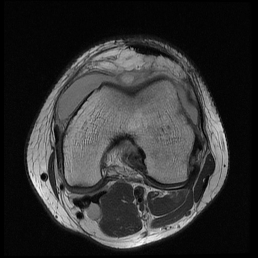 File:Anterior cruciate ligament tear (Radiopaedia 61500-69462 Axial PD 10).jpg