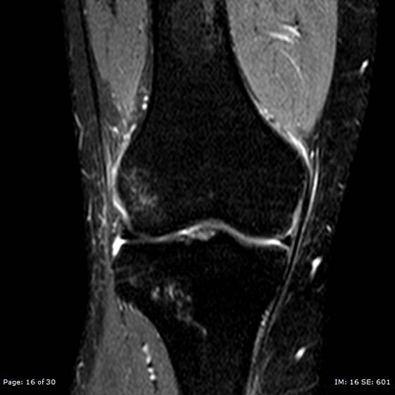 File:Anterior cruciate ligament tear (Radiopaedia 70783-80964 Coronal STIR 16).jpg