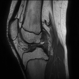 Anterior cruciate ligament tear - pediatric (Radiopaedia 62152-70260 Sagittal PD 96).jpg
