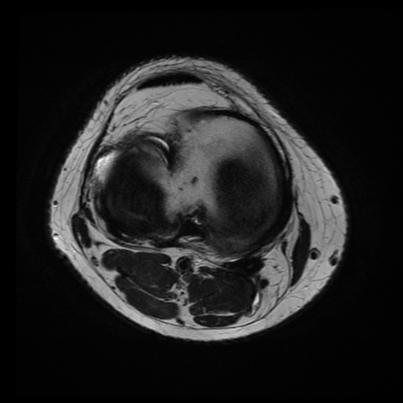 File:Anterior cruciate ligament tear with posteromedial corner injury, bucket-handle meniscal tear and chondral delamination (Radiopaedia 75501-86744 Axial T2 8).jpg