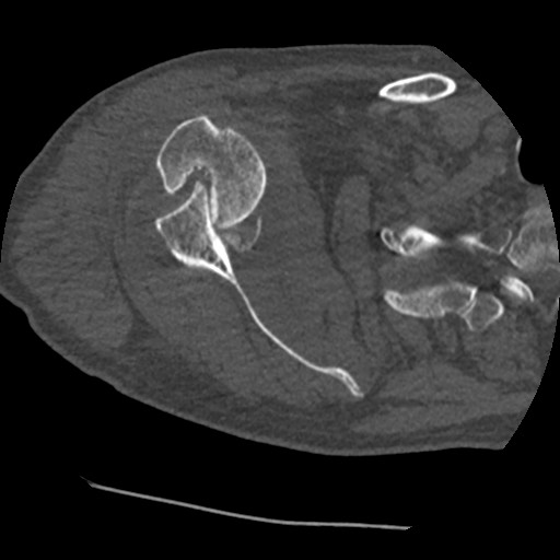 Anterior glenohumeral dislocation with Hill-Sachs lesion (Radiopaedia 62877-71249 Axial bone window 38).jpg