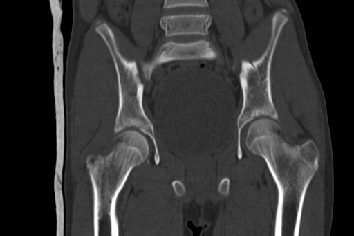 Anterior inferior iliac spine avulsion injury (Radiopaedia 88666-105376 Coronal bone window 38).jpg