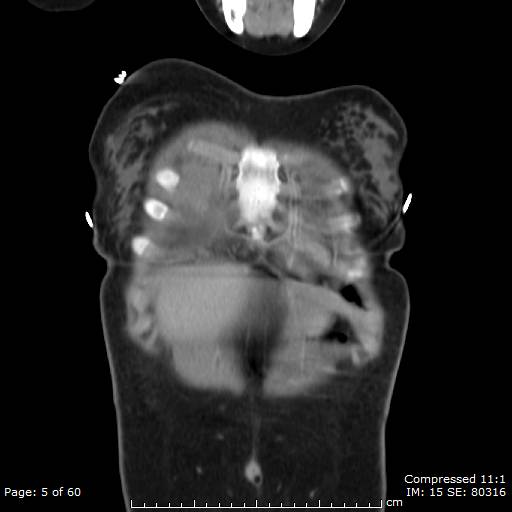 File:Anterior mediastinal B cell Lymphoma (Radiopaedia 50677-56114 B 3).jpg