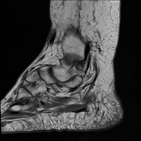 File:Anterior talofibular ligament injury - rupture with soft-tissue impingement (Radiopaedia 38765-40928 Sagittal PD 5).jpg