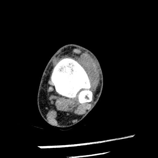 File:Anterior tibial artery false aneurysm (Radiopaedia 88984-105809 A 92).jpg