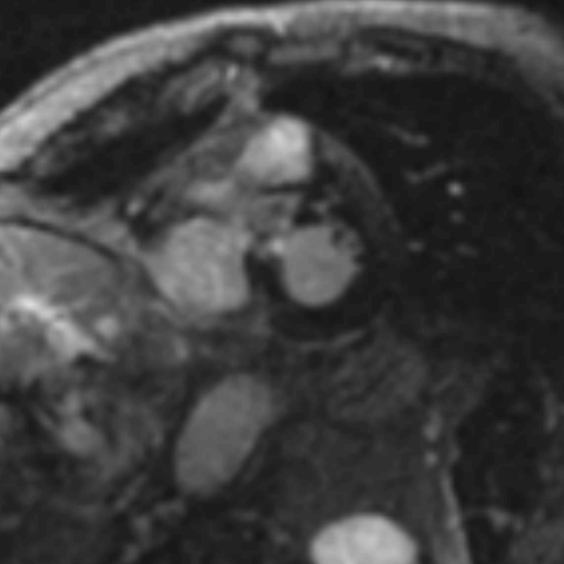 File:Anteroseptal hypokinesia after myocardial infarction (Radiopaedia 15978-15633 I 3).jpg