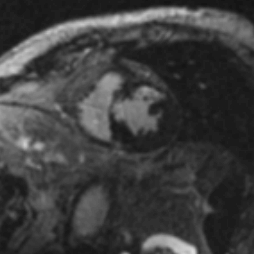 File:Anteroseptal hypokinesia after myocardial infarction (Radiopaedia 15978-15633 I 4).jpg