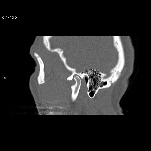File:Antrochoanal Polyp (Radiopaedia 70510-80631 Sagittal bone window 3).jpg