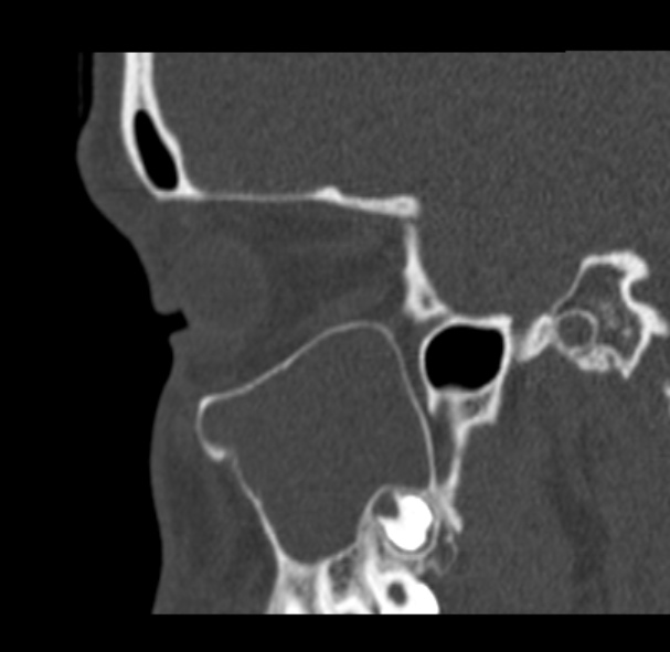 Antrochoanal polyp (Radiopaedia 33984-35202 Sagittal bone window 21).jpg