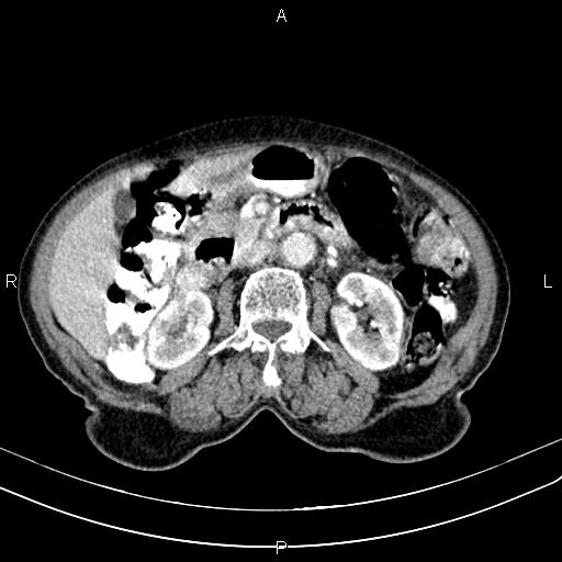 File:Aortic aneurysm and Lemmel syndrome (Radiopaedia 86499-102554 A 36).jpg