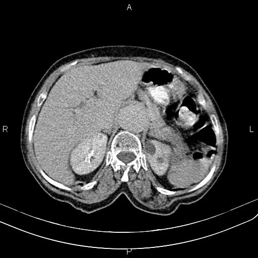 File:Aortic aneurysm and Lemmel syndrome (Radiopaedia 86499-102554 Axial C+ delayed 22).jpg