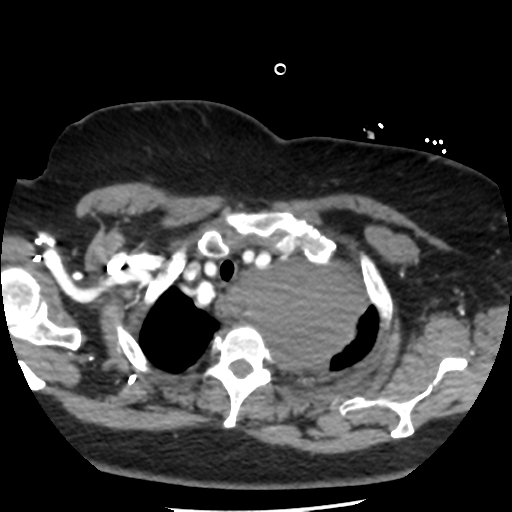 Aortic aneurysm and dissection - Stanford type A (Radiopaedia 36693-38261 A 12).png
