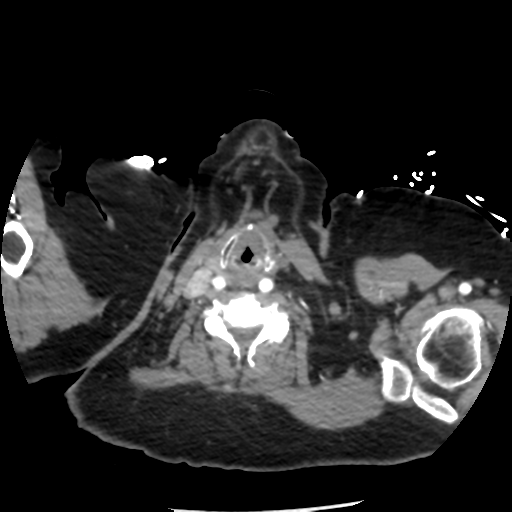 File:Aortic aneurysm and dissection - Stanford type A (Radiopaedia 36693-38261 A 2).png