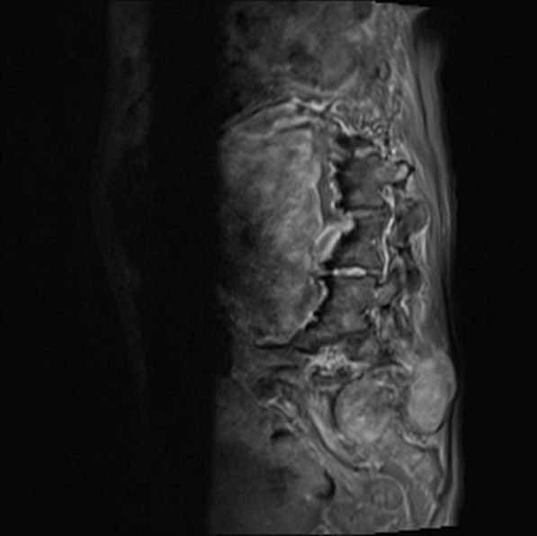 File:Aortic aneurysm with spinal destruction (Radiopaedia 42301-45409 Sagittal T1 fat sat 32).jpg