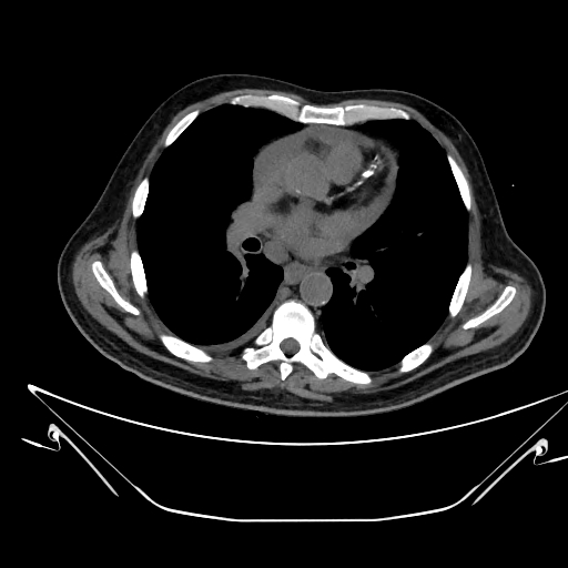 Aortic arch aneurysm (Radiopaedia 84109-99365 Axial non-contrast 144).jpg