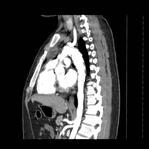 File:Aortic arch stent (Radiopaedia 30030-30595 E 12).jpg