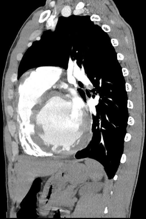 Aortic coarctation with aneurysm (Radiopaedia 74818-85828 B 104).jpg